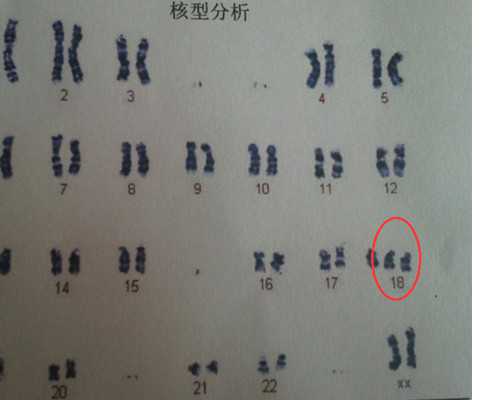 孕期什么情况会导致空囊 卫恩李冉保胎